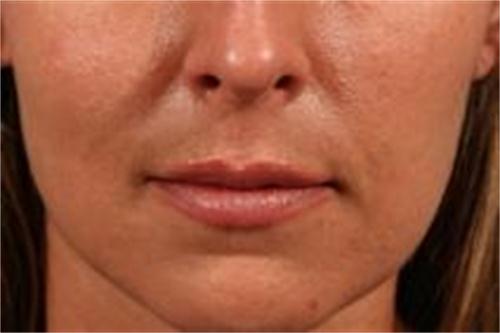 Fillers 3 dopo